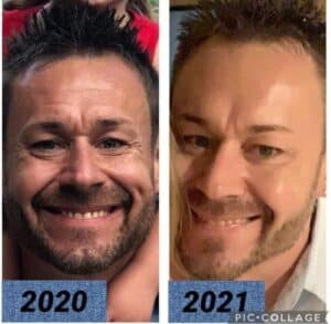 LumiSpa Before and After User Male 2020-2021