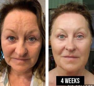LumiSpa Before and After Female 4 Weeks